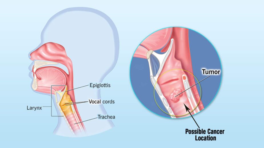 A medical illustration showing a side view of the human head and throat with labeled anatomical parts (epiglottis, larynx, vocal cords, trachea) and a close-up circular in-set highlighting a tumor location near the throat.